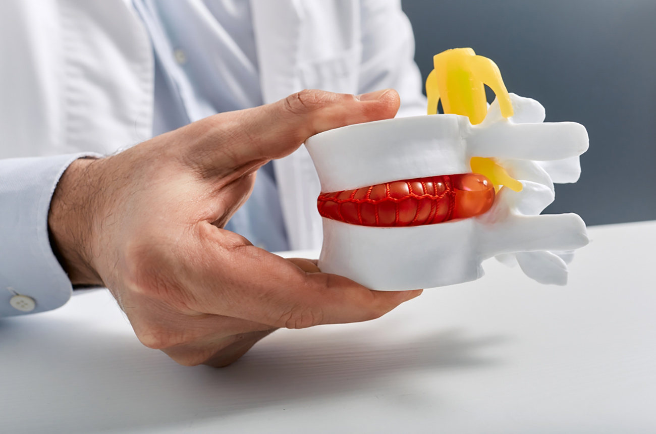 Herniated Disc: Healing Stages And Timeline (Part 4)